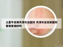 儿童牛皮癣天津长征医院 天津长征皮肤医院看银屑病好吗