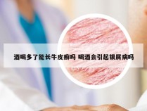 酒喝多了能长牛皮癣吗 喝酒会引起银屑病吗