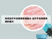 民间治疗牛皮癣银屑病偏方 治疗牛皮癣银屑病的偏方