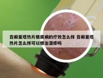 百癣夏塔热片银屑病的疗效怎么样 百癣夏塔热片怎么样可以根治湿疹吗
