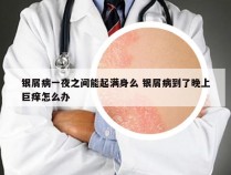 银屑病一夜之间能起满身么 银屑病到了晚上巨痒怎么办
