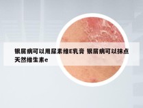 银屑病可以用尿素维E乳膏 银屑病可以抹点天然维生素e