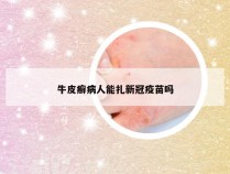 牛皮癣病人能扎新冠疫苗吗
