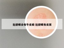 肚脐眼会有牛皮癣 肚脐眼有皮屑