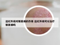远红外线对银屑病的作用 远红外线可以治疗银屑病吗