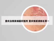 重庆治银屑病最好医院 重庆银屑病排名第一