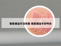 银屑病治疗没效果 银屑病治不好咋办
