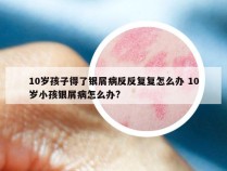 10岁孩子得了银屑病反反复复怎么办 10岁小孩银屑病怎么办?