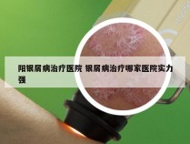 阳银屑病治疗医院 银屑病治疗哪家医院实力强