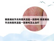 银屑病关节炎和类风湿是一回事吗 银屑病关节炎和类风湿是一回事吗怎么治疗