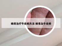 蜂房治疗牛皮癣方法 蜂毒治牛皮癣