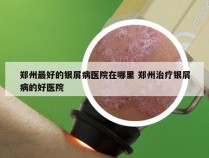郑州最好的银屑病医院在哪里 郑州治疗银屑病的好医院