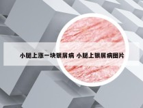 小腿上涨一块银屑病 小腿上银屑病图片