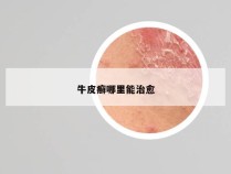 牛皮癣哪里能治愈
