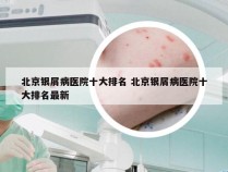 北京银屑病医院十大排名 北京银屑病医院十大排名最新