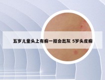 五岁儿童头上有癣一抠会出灰 5岁头皮癣