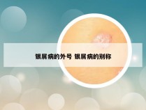 银屑病的外号 银屑病的别称