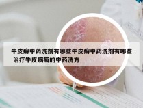 牛皮癣中药洗剂有哪些牛皮癣中药洗剂有哪些 治疗牛皮病癣的中药洗方