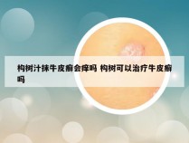 构树汁抹牛皮癣会痒吗 构树可以治疗牛皮癣吗