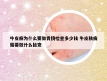 牛皮癣为什么要做胃镜检查多少钱 牛皮肤癣需要做什么检查