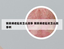 银屑病老起皮怎么回事 银屑病老起皮怎么回事啊