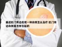 最近肛门旁边出现一块白斑怎么治疗 肛门旁边白斑是怎样引起的