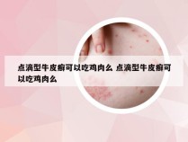 点滴型牛皮癣可以吃鸡肉么 点滴型牛皮癣可以吃鸡肉么