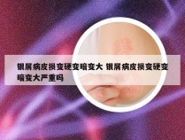 银屑病皮损变硬变暗变大 银屑病皮损变硬变暗变大严重吗