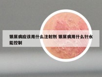 银屑病应该用什么注射剂 银屑病用什么针水能控制