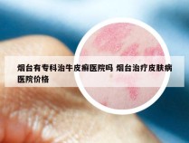烟台有专科治牛皮癣医院吗 烟台治疗皮肤病医院价格