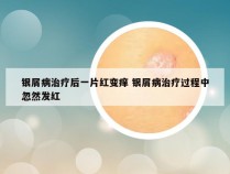 银屑病治疗后一片红变痒 银屑病治疗过程中忽然发红