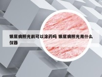 银屑病照光前可以涂药吗 银屑病照光用什么仪器