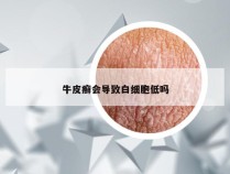 牛皮癣会导致白细胞低吗