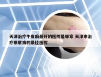 天津治疗牛皮癣最好的医院是哪家 天津市治疗银屑病的最佳医院
