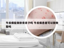 牛皮癣能做肋骨鼻子吗 牛皮癣患者可以做微整吗