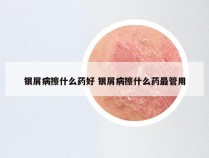 银屑病擦什么药好 银屑病擦什么药最管用