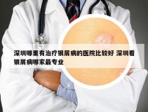 深圳哪里有治疗银屑病的医院比较好 深圳看银屑病哪家最专业