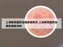 上海哪家医院治银屑病有效 上海哪家医院治银屑病有效的