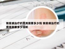 银屑病治疗的费用需要多少钱 银屑病治疗的费用需要多少钱呢