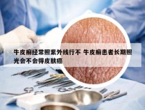 牛皮癣经常照紫外线行不 牛皮癣患者长期照光会不会得皮肤癌