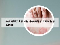 牛皮癣好了上面长包 牛皮癣好了上面长包怎么回事