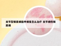 关节型银屑病指甲病变怎么治疗 关节病性银屑病