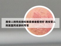 西安二附院皮肤科银屑病谁看得好 西安第二附属医院皮肤科专家