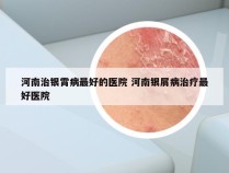 河南治银霄病最好的医院 河南银屑病治疗最好医院