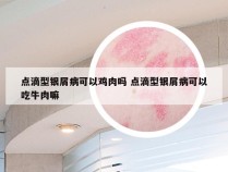 点滴型银屑病可以鸡肉吗 点滴型银屑病可以吃牛肉嘛