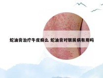 蛇油膏治疗牛皮癣么 蛇油膏对银屑病有用吗