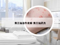 焦三仙治牛皮癣 焦三仙药方