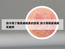 孩子得了银屑病我真的想死 孩子得银屑病真实案例