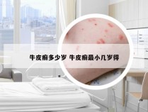 牛皮癣多少岁 牛皮癣最小几岁得
