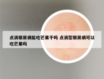 点滴银屑病能吃芒果干吗 点滴型银屑病可以吃芒果吗